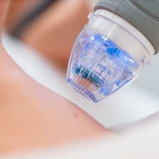 Microneedling Corporal Bilbao Estética