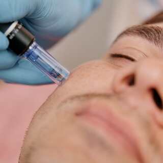 Microneedling Bilbao Miren Rodríguez