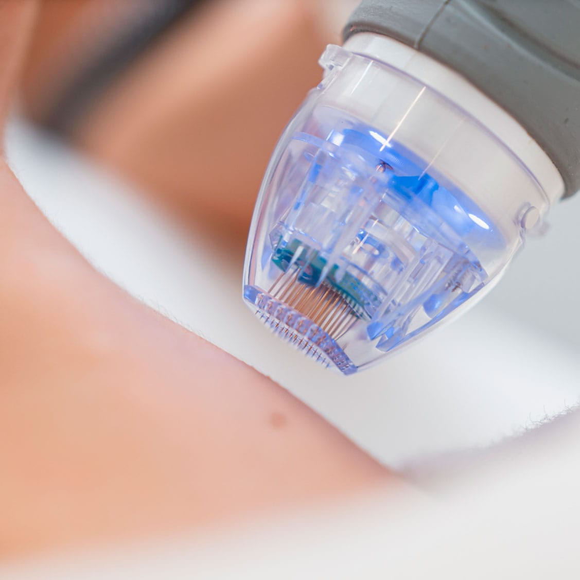 Microneedling Corporal Bilbao Estética